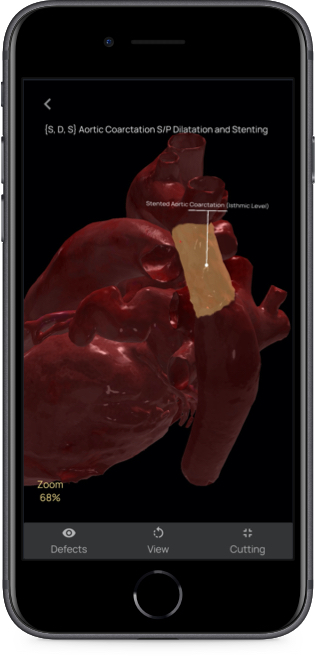 App evidenzia sezione del cuore 3D soggetta a difetti
